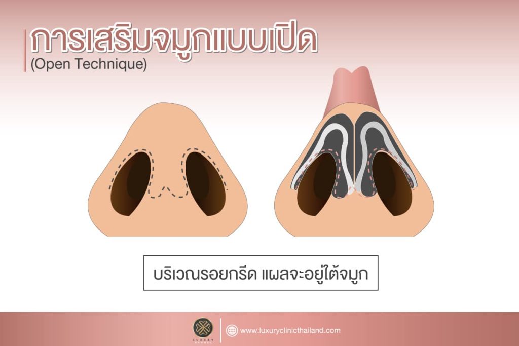 การเสริมจมูกแบบเปิด