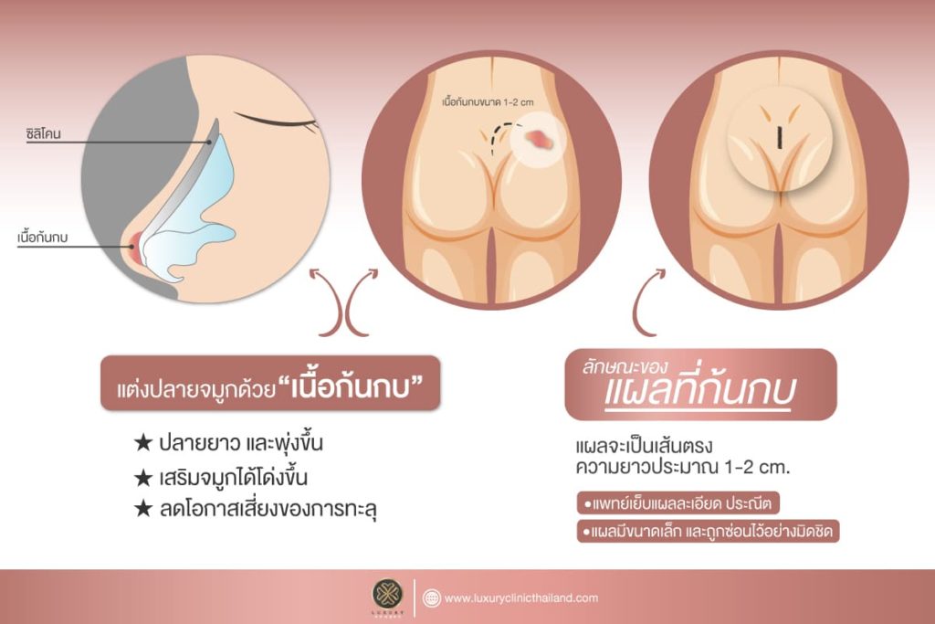 แต่งปลายจมูกด้วยเนื้อก้นกบ