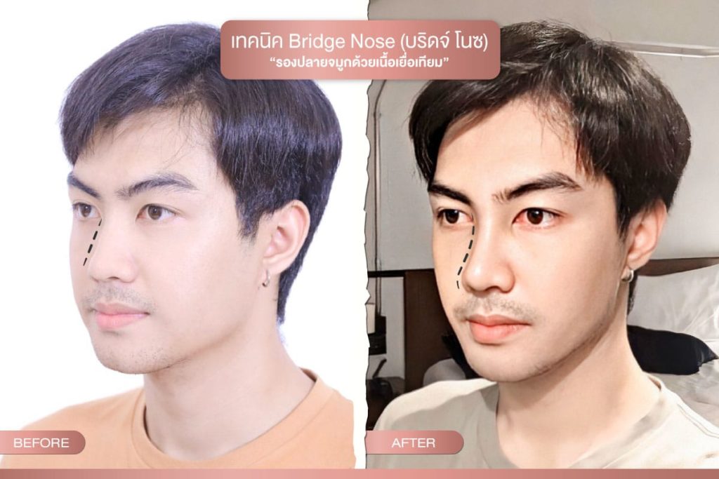 เทคนิค Bridge Nose