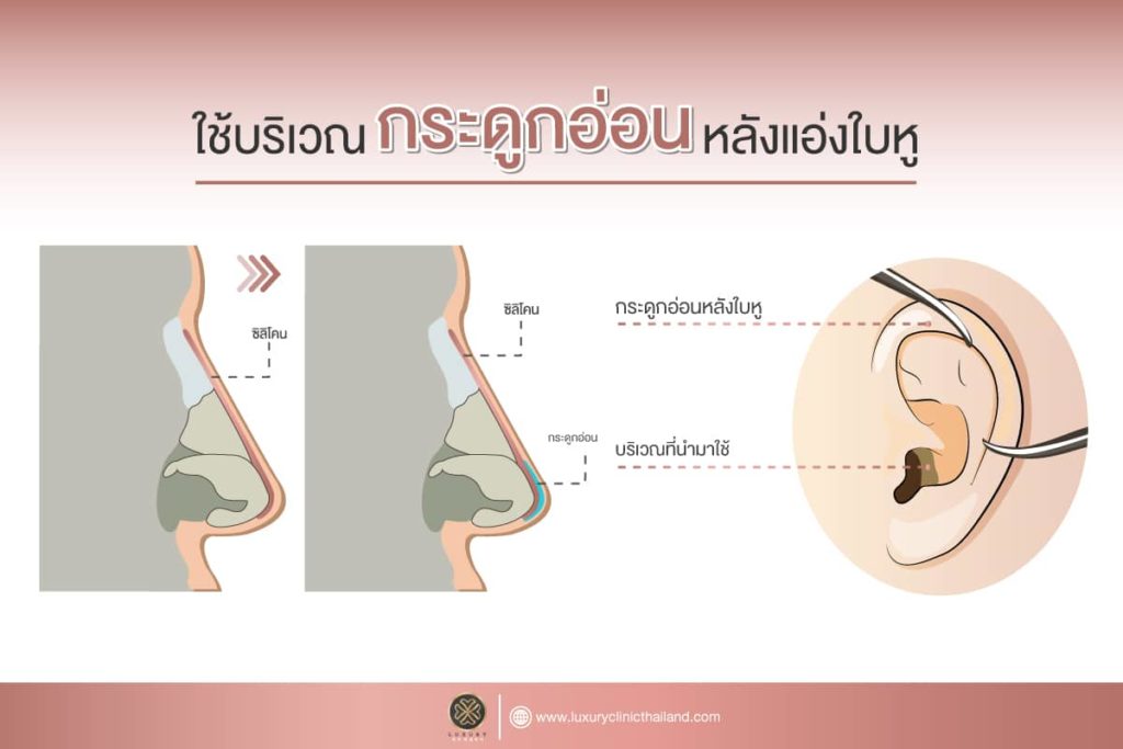 ใช้บริเวณกระดูกอ่อนหลังแอ่งใบหู