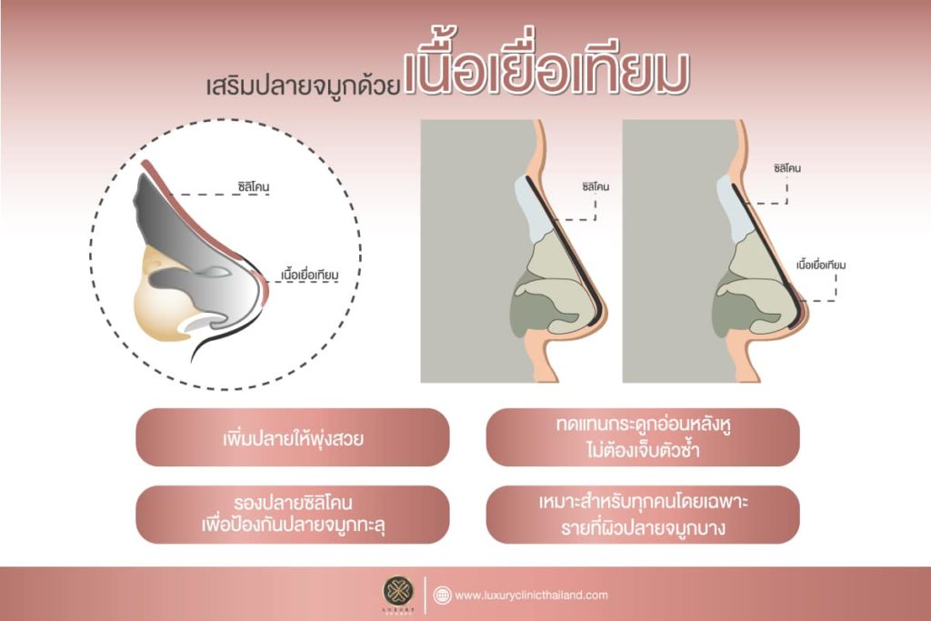 เสริมปลายจมูกด้วยเนื้อเยื้อเทียม