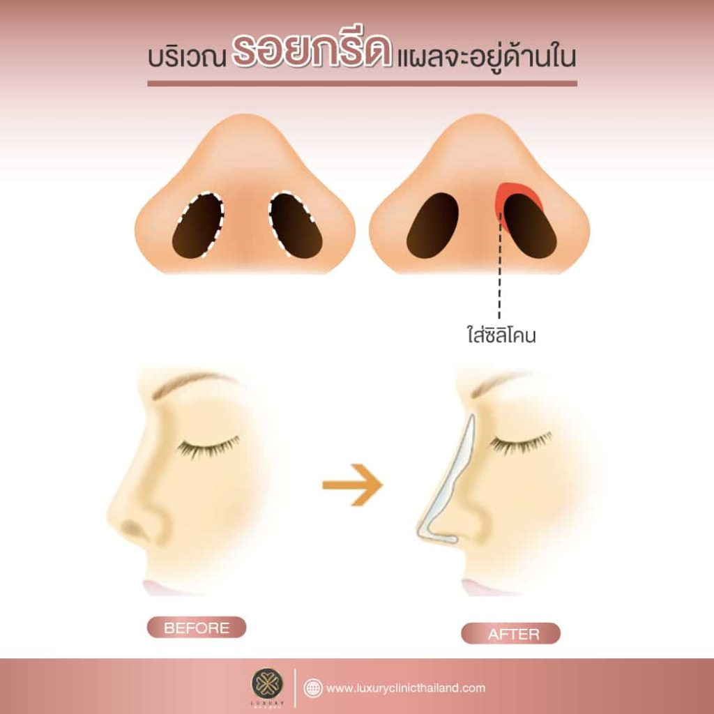 เทคนิค Rhinoplasty
