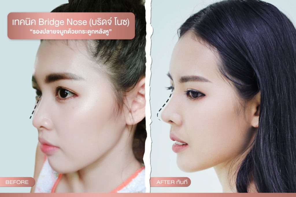 รองปลายจมูกด้วยกระดูกหลังหู