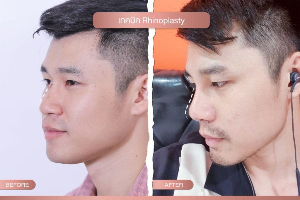 เทคนิค Rhinoplasty