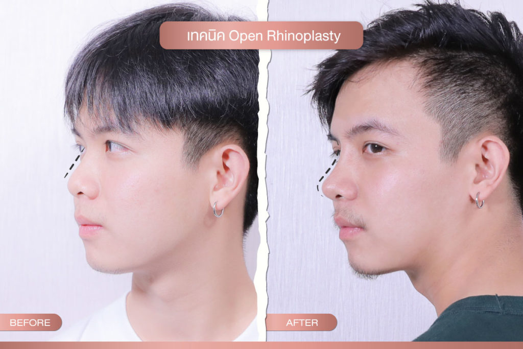 เทคนิค open rhinoplasty