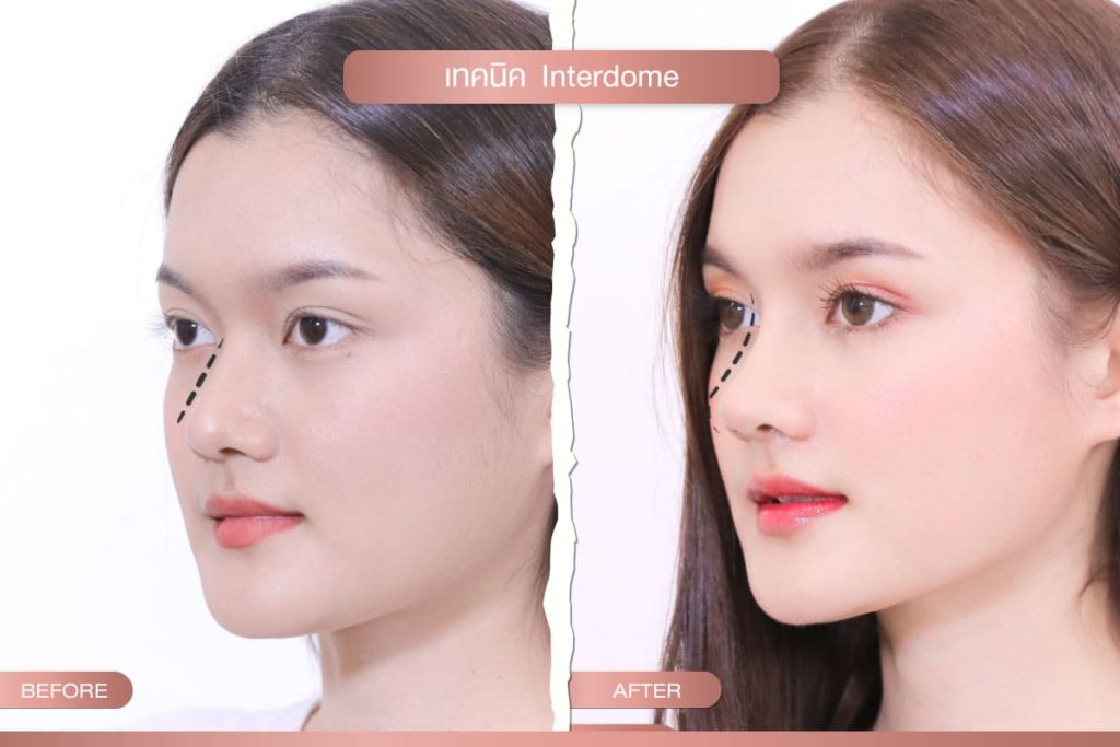 เทคนิค Interdome