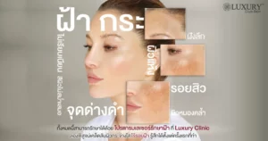 Q-Switch Laser รักษาฝ้า กระ | Luxury Clinic