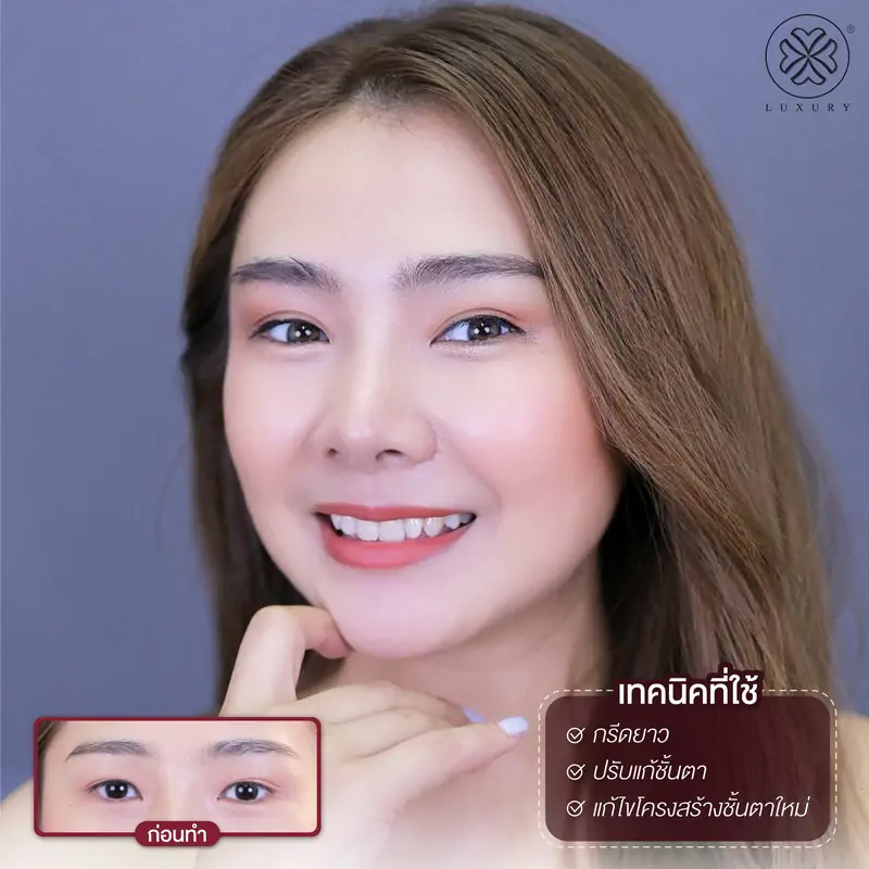 รีวิวตาสองชั้น รีวิวทำตา รีวิวทำตาสองชั้น รีวิวทำตาสองชั้นสวย luxury clinic