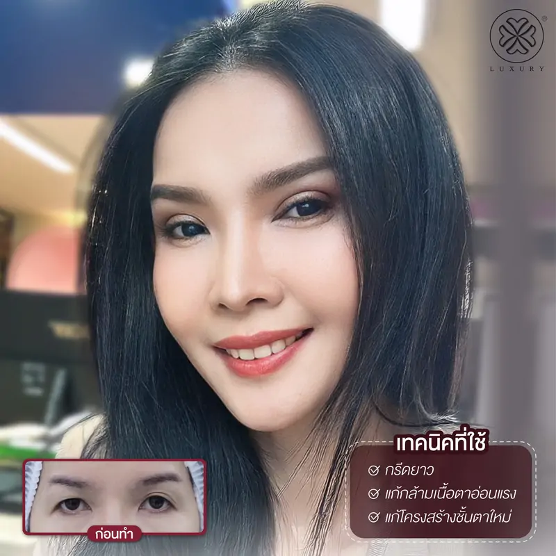 รีวิวตาสองชั้น รีวิวทำตา รีวิวทำตาสองชั้น รีวิวทำตาสองชั้นสวย luxury clinic