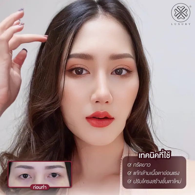 รีวิวตาสองชั้น รีวิวทำตา รีวิวทำตาสองชั้น รีวิวทำตาสองชั้นสวย luxury clinic