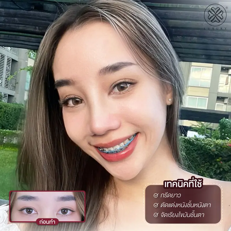 รีวิวตาสองชั้น รีวิวทำตา รีวิวทำตาสองชั้น รีวิวทำตาสองชั้นสวย luxury clinic