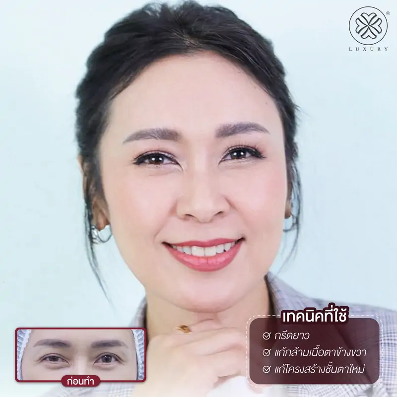 รีวิวตาสองชั้น รีวิวทำตา รีวิวทำตาสองชั้น รีวิวทำตาสองชั้นสวย luxury clinic