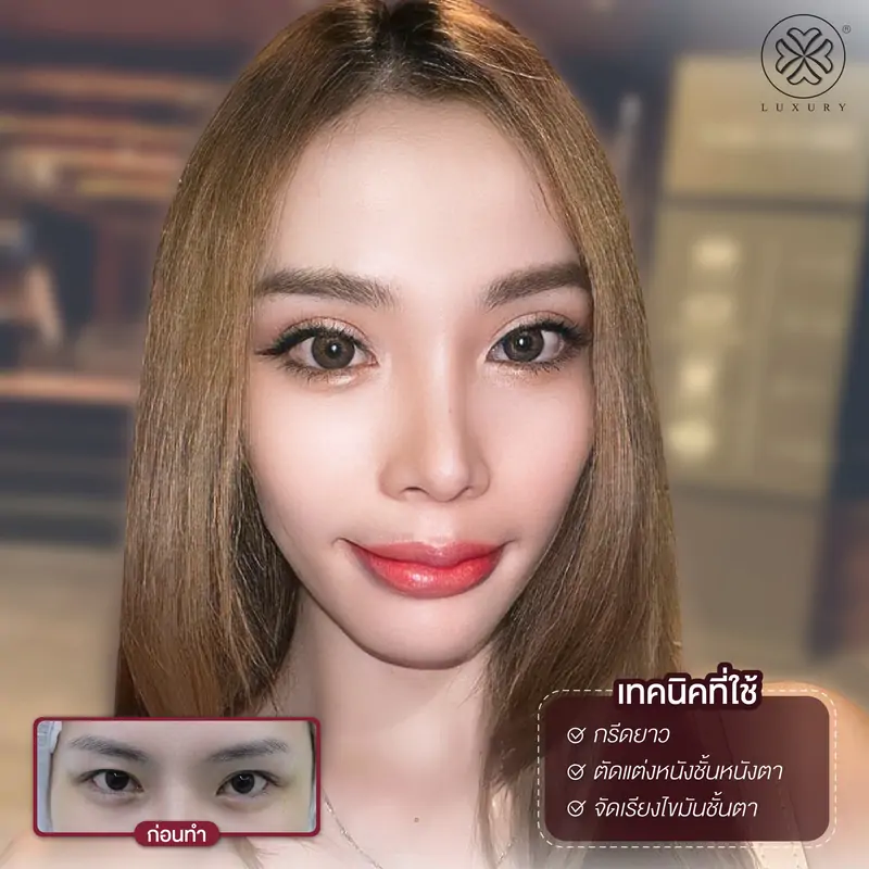 รีวิวตาสองชั้น รีวิวทำตา รีวิวทำตาสองชั้น รีวิวทำตาสองชั้นสวย luxury clinic