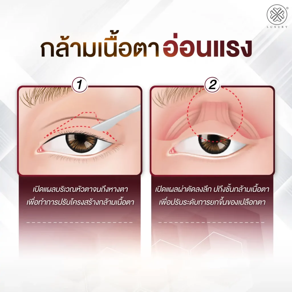 กล้ามเนื้อตาอ่อนแรง แก้ไขกล้ามเนื้อตาอ่อนแรง กล้ามเนื้อตาอ่อนแรง luxury clinic