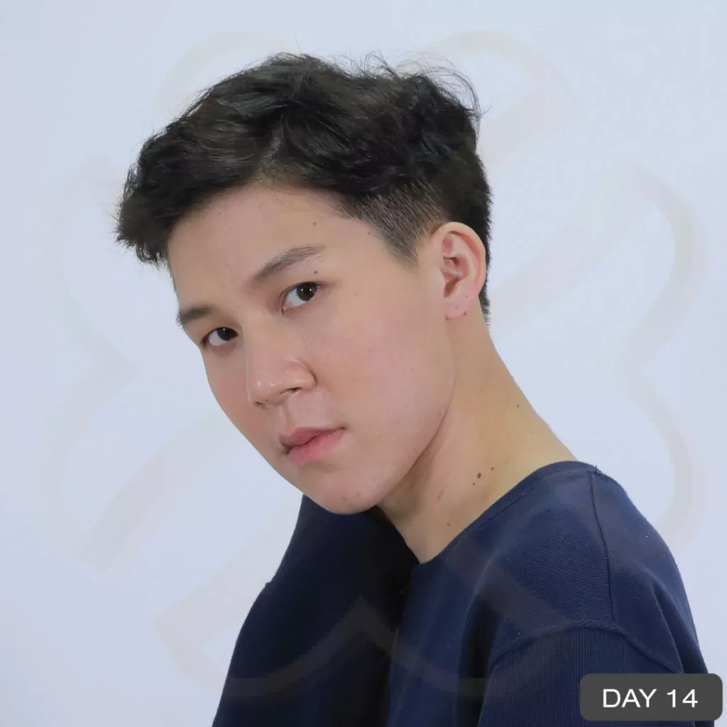 หูกาง ทำให้สูญเสียความมั่นใจ