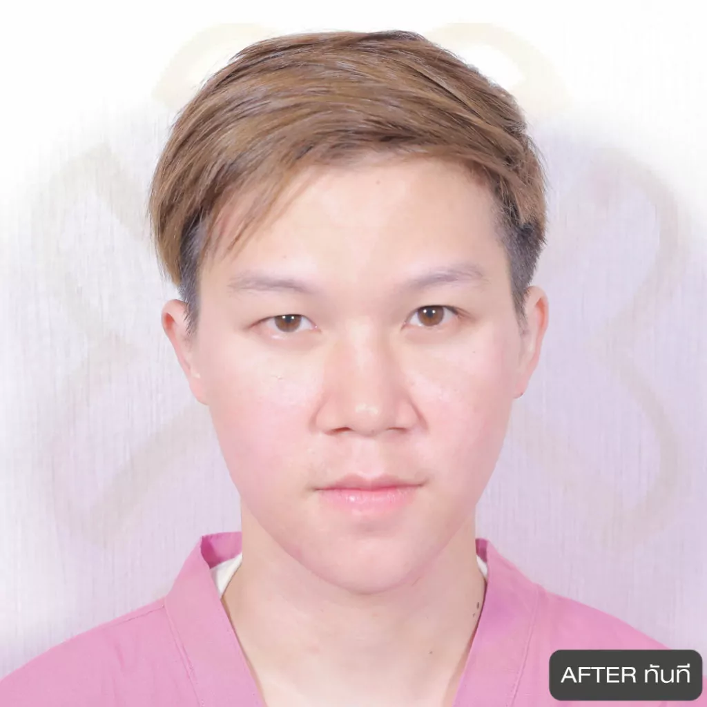 หูกาง ทำให้สูญเสียความมั่นใจ