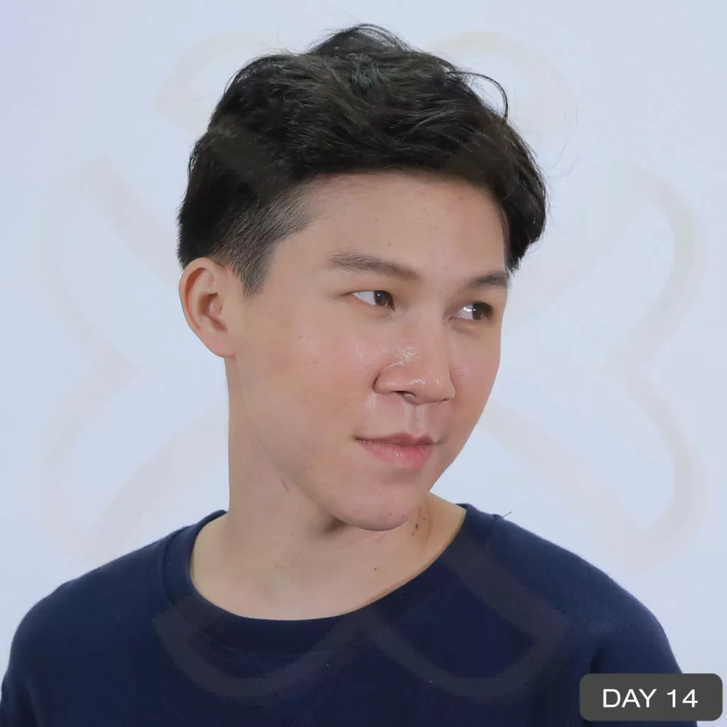 หูกาง ทำให้สูญเสียความมั่นใจ