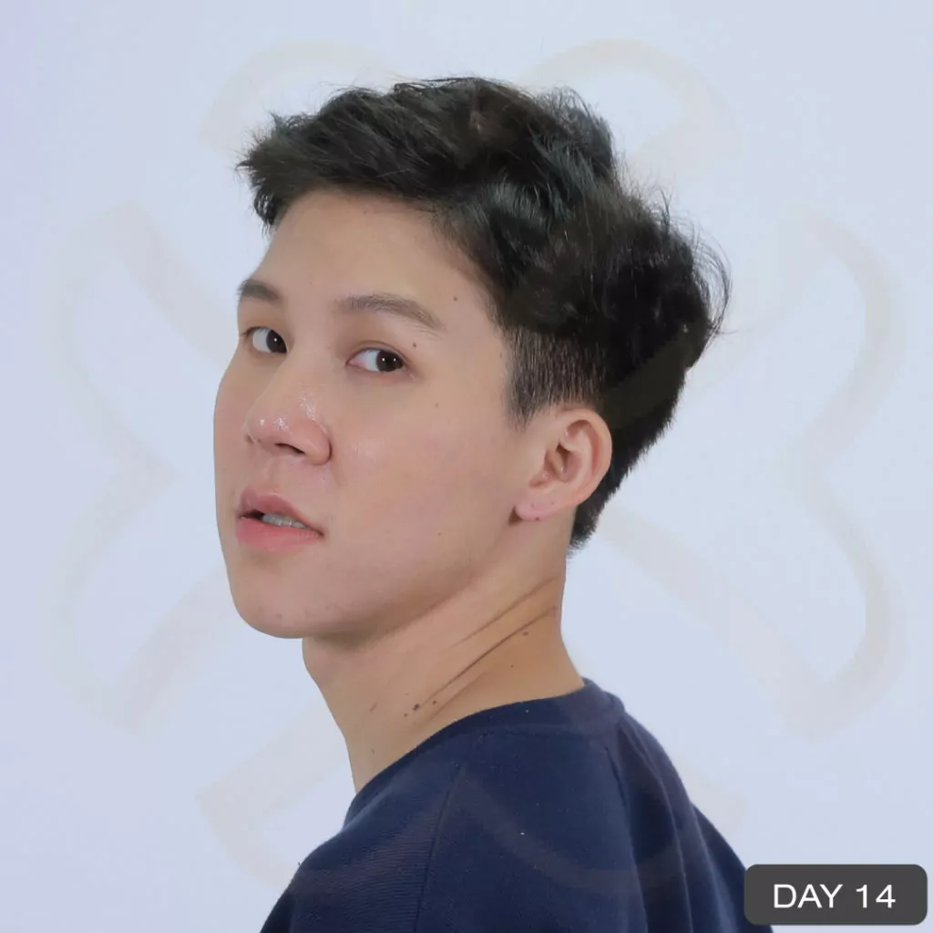 หูกาง ทำให้สูญเสียความมั่นใจ