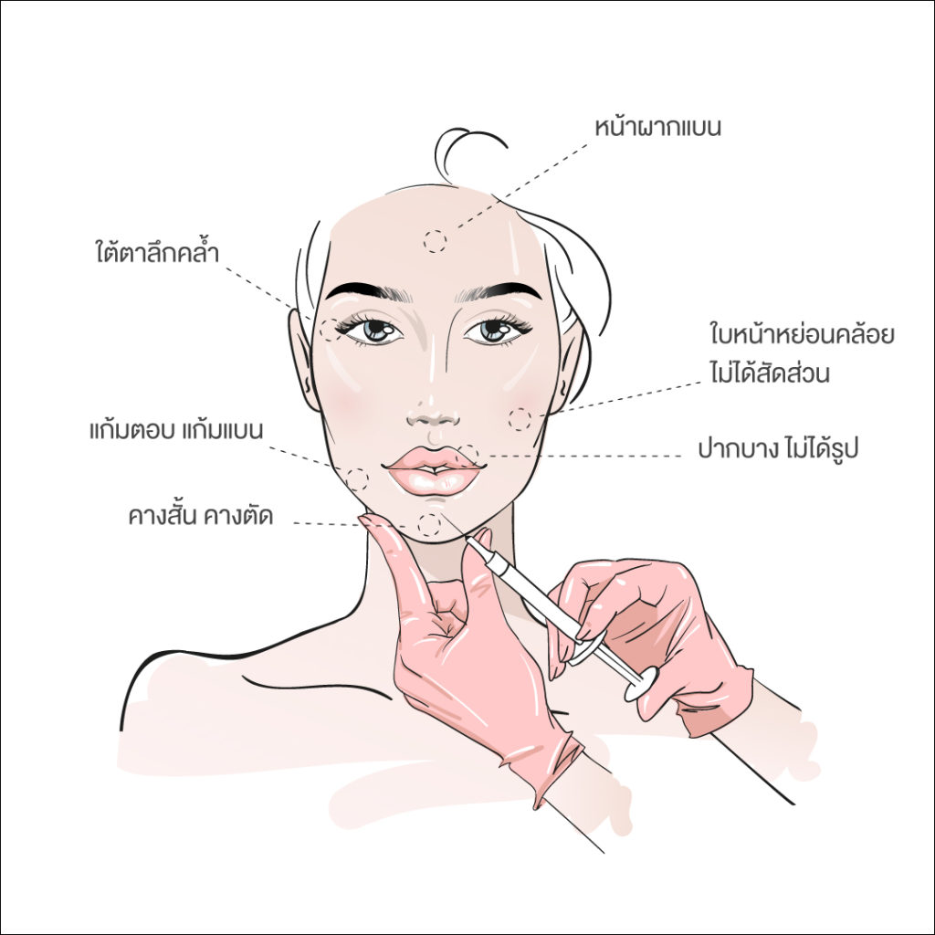 การฉีด filler
