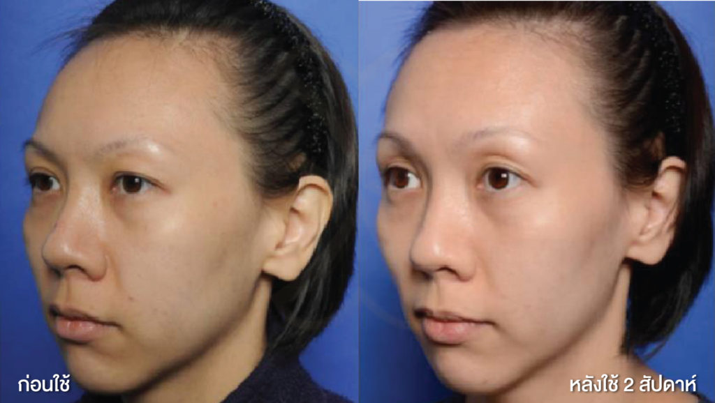 before after