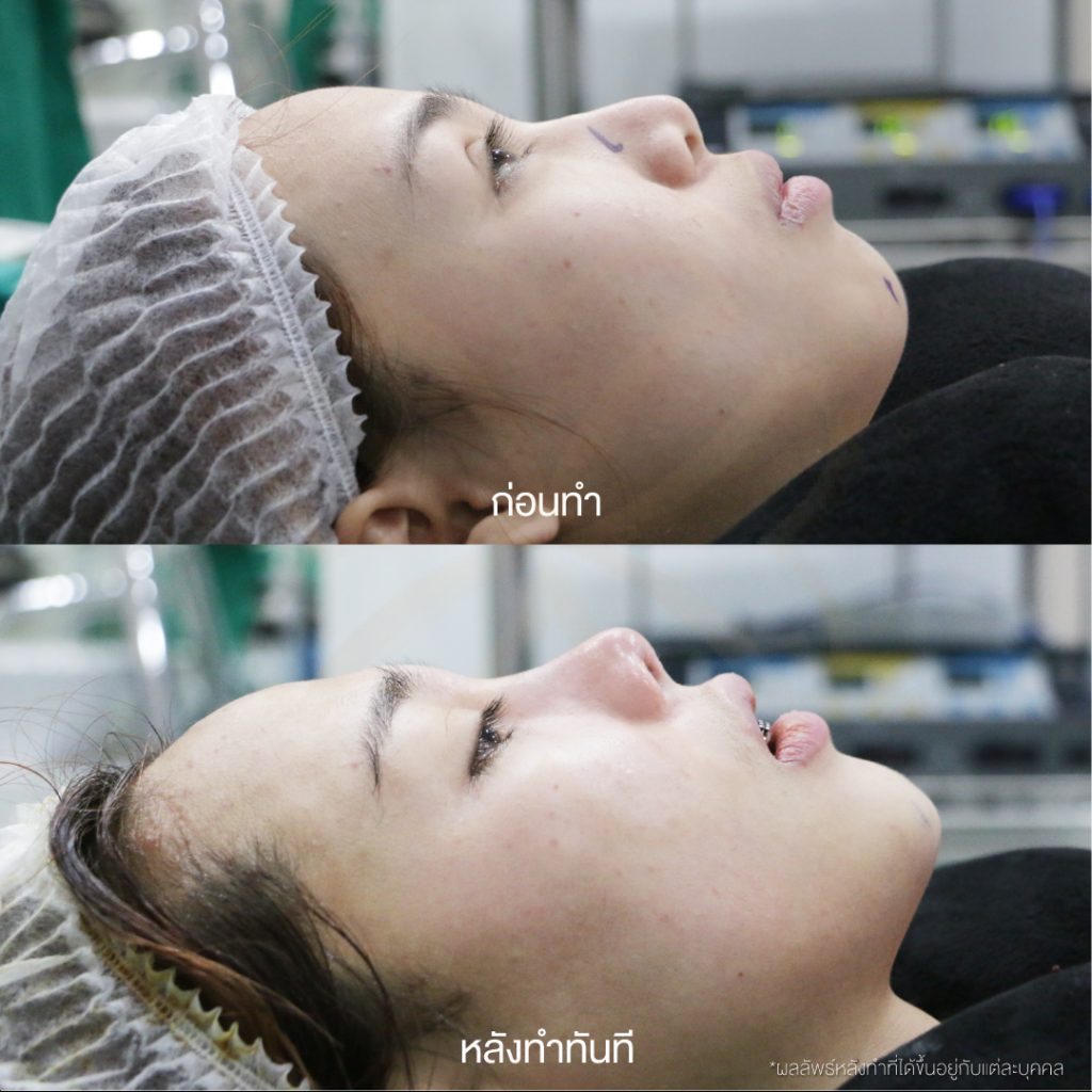 ก่อนและหลังทำคางทันที