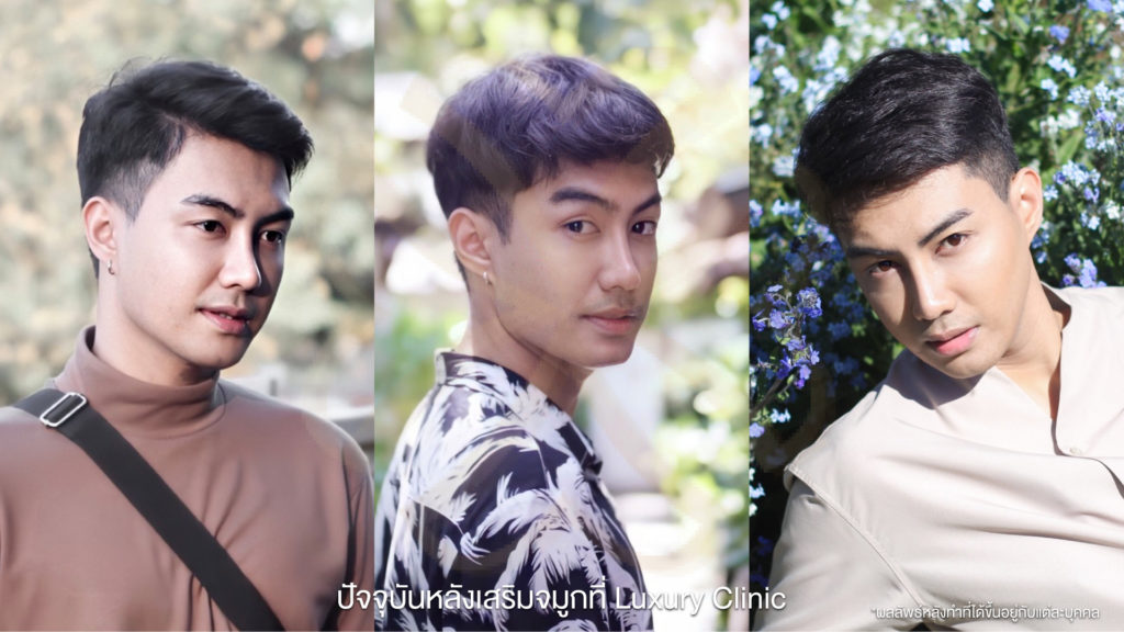 ปัจจุบันหลังเสริมจมูกที่ luxury clinic 2