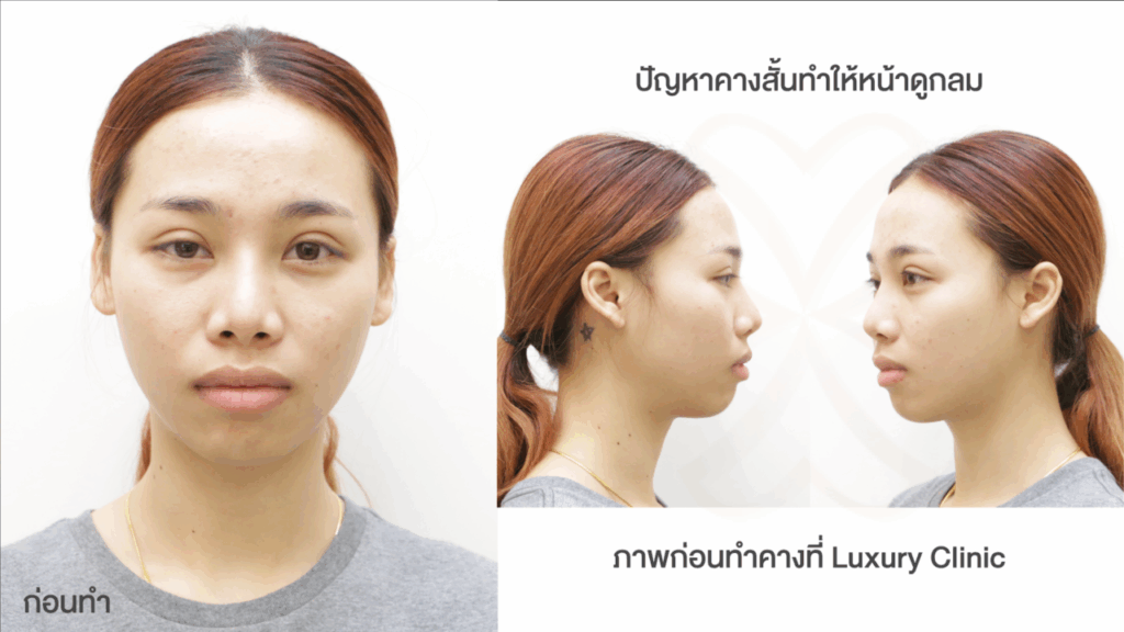 เสริมคาง