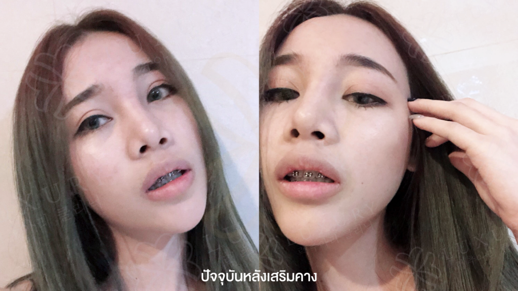 ปัจจุบันหลังเสริมคาง