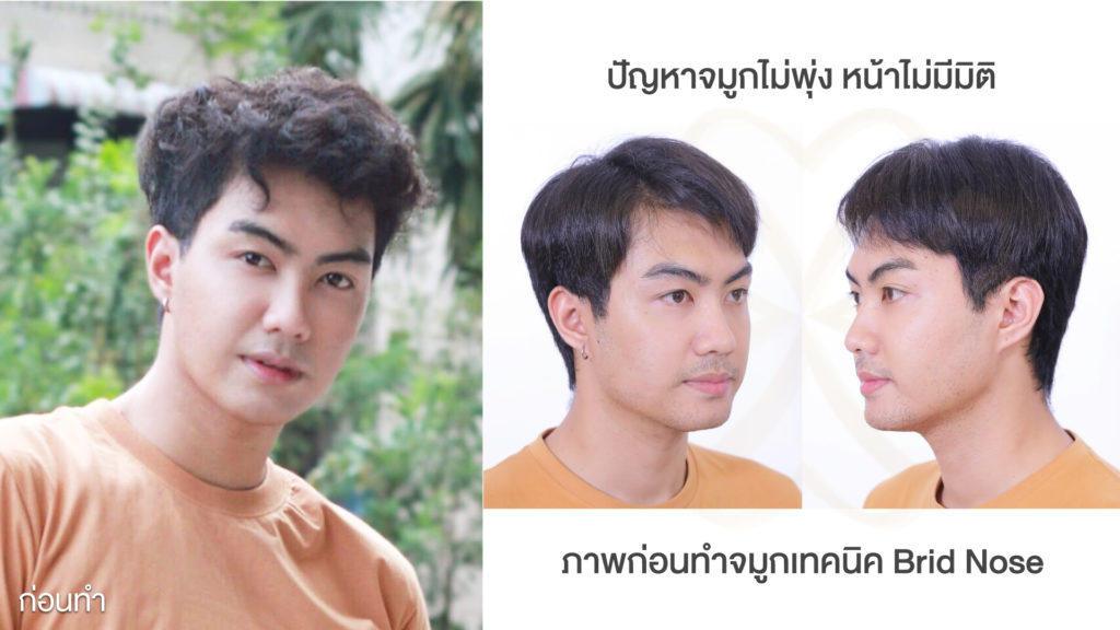 รีวิวเสริมจมูก