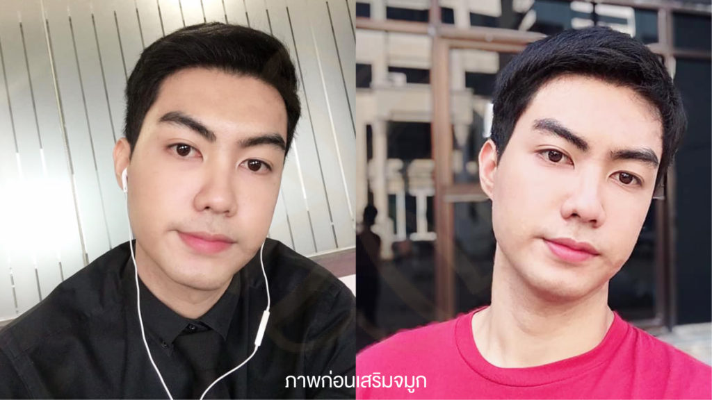 ภาพก่อนเสริมจมูก