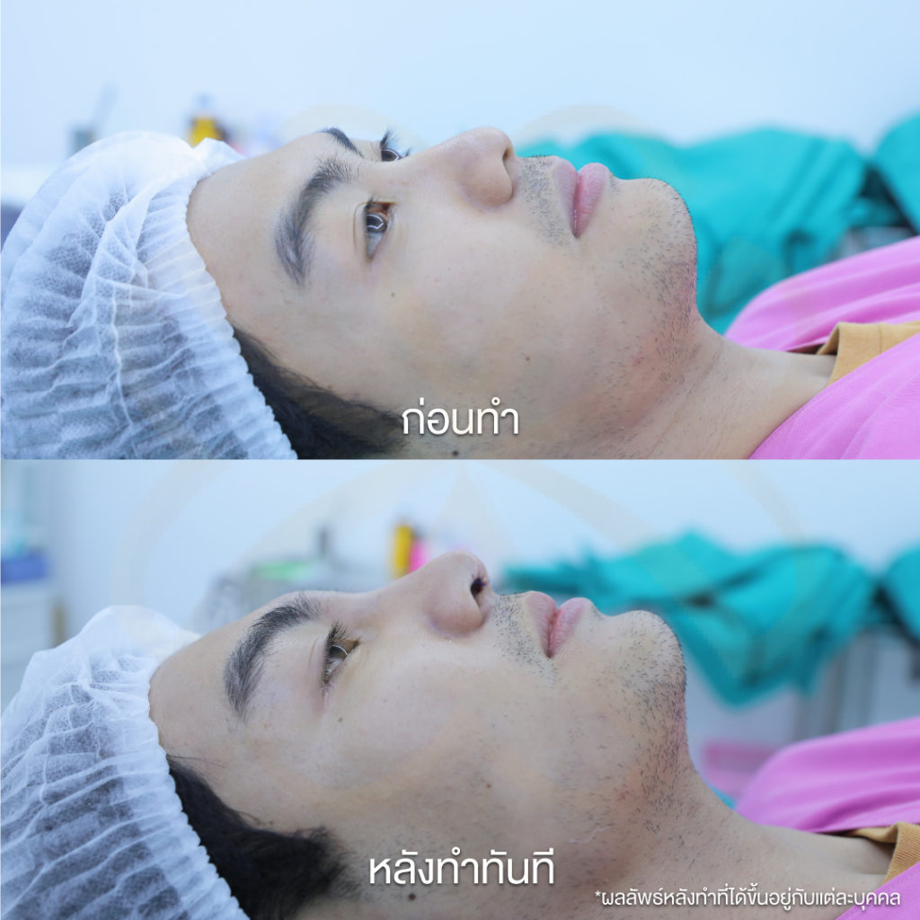 ก่อน-หลังทำทันที