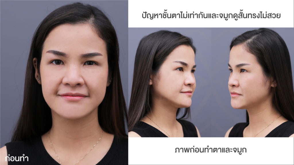 รีวิวทำจมูกและทำตาสองชั้น