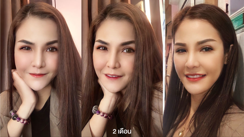 หลังจากทำตาและจมูก 2 เดือน