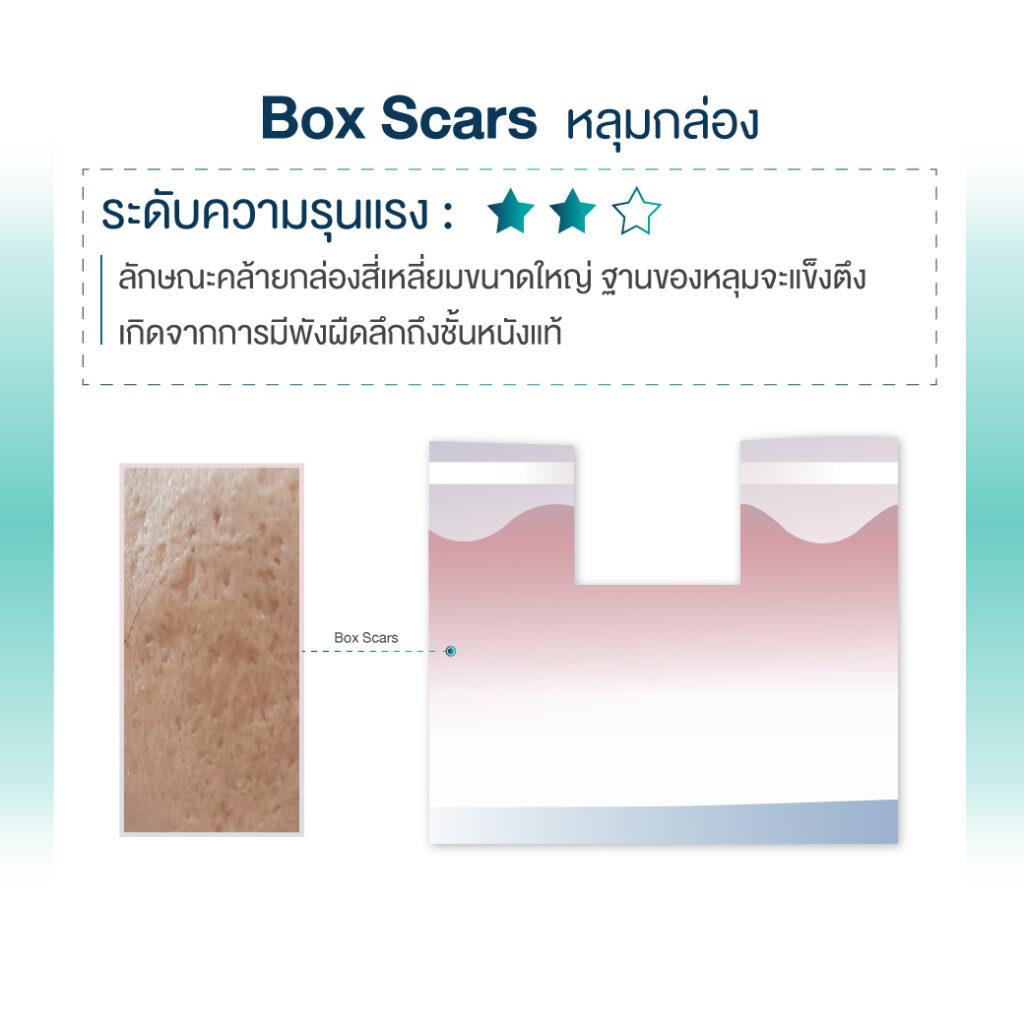 Box Scars หลุมกล่อง