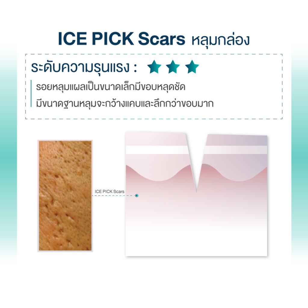 Ice Pick Scars