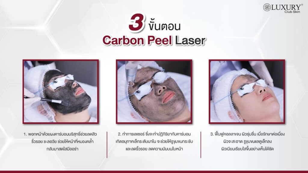 3 ขั้นตอน carbon peel laser