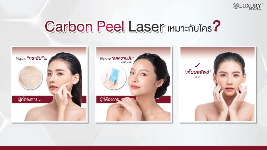 carbon peel laser เหมาะกับใคร