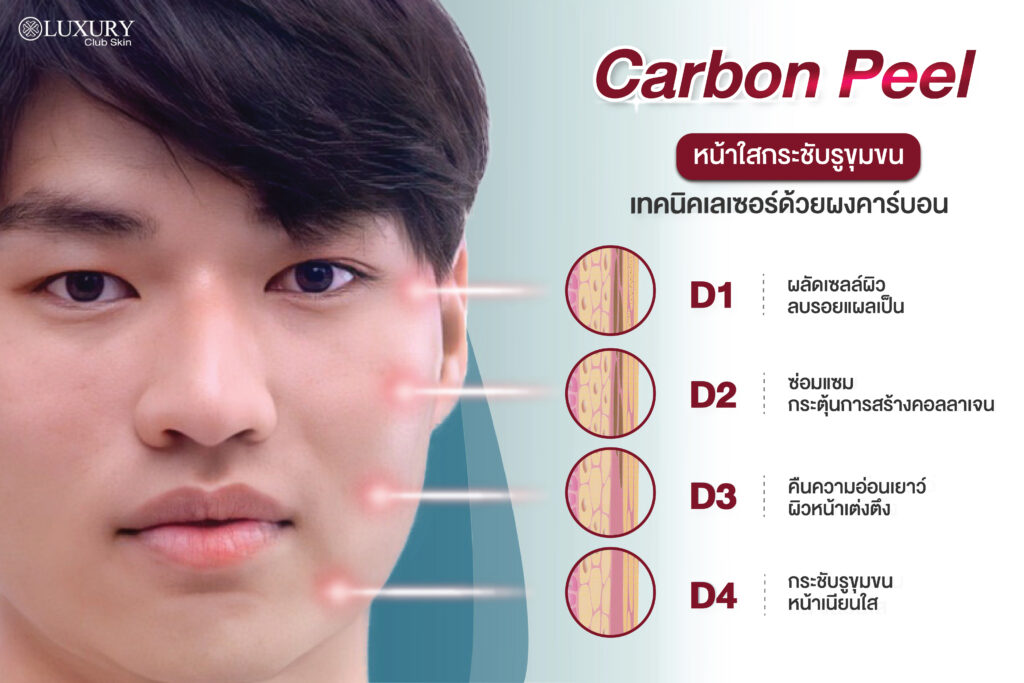 carbon peel laser หน้าใสกระชับรูขุมขน