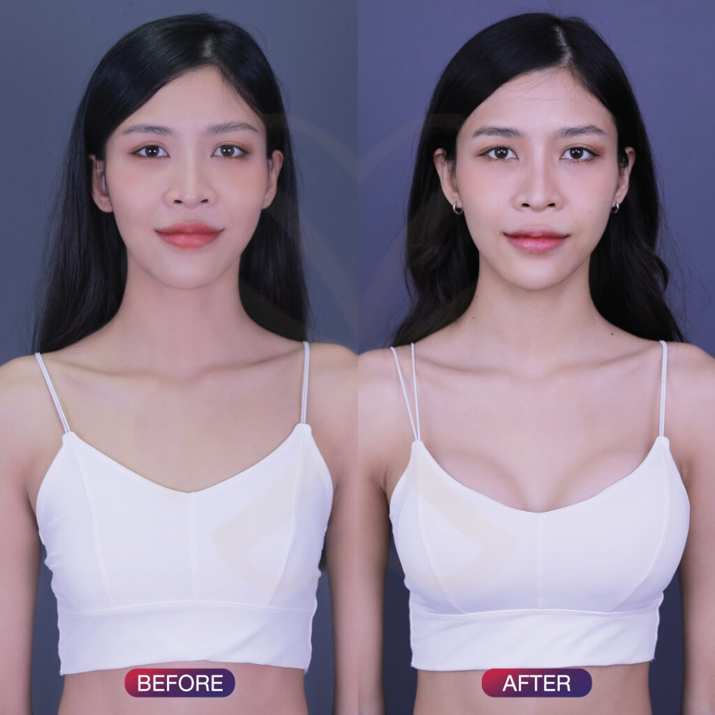 before-after เสริมหน้าอก