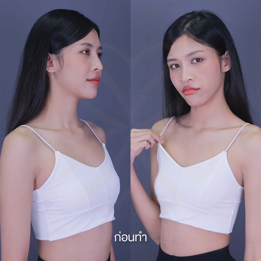 เสริมหน้าอก