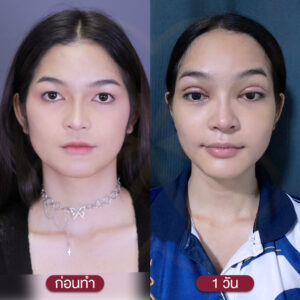 ระยะเวลาพักฟื้น