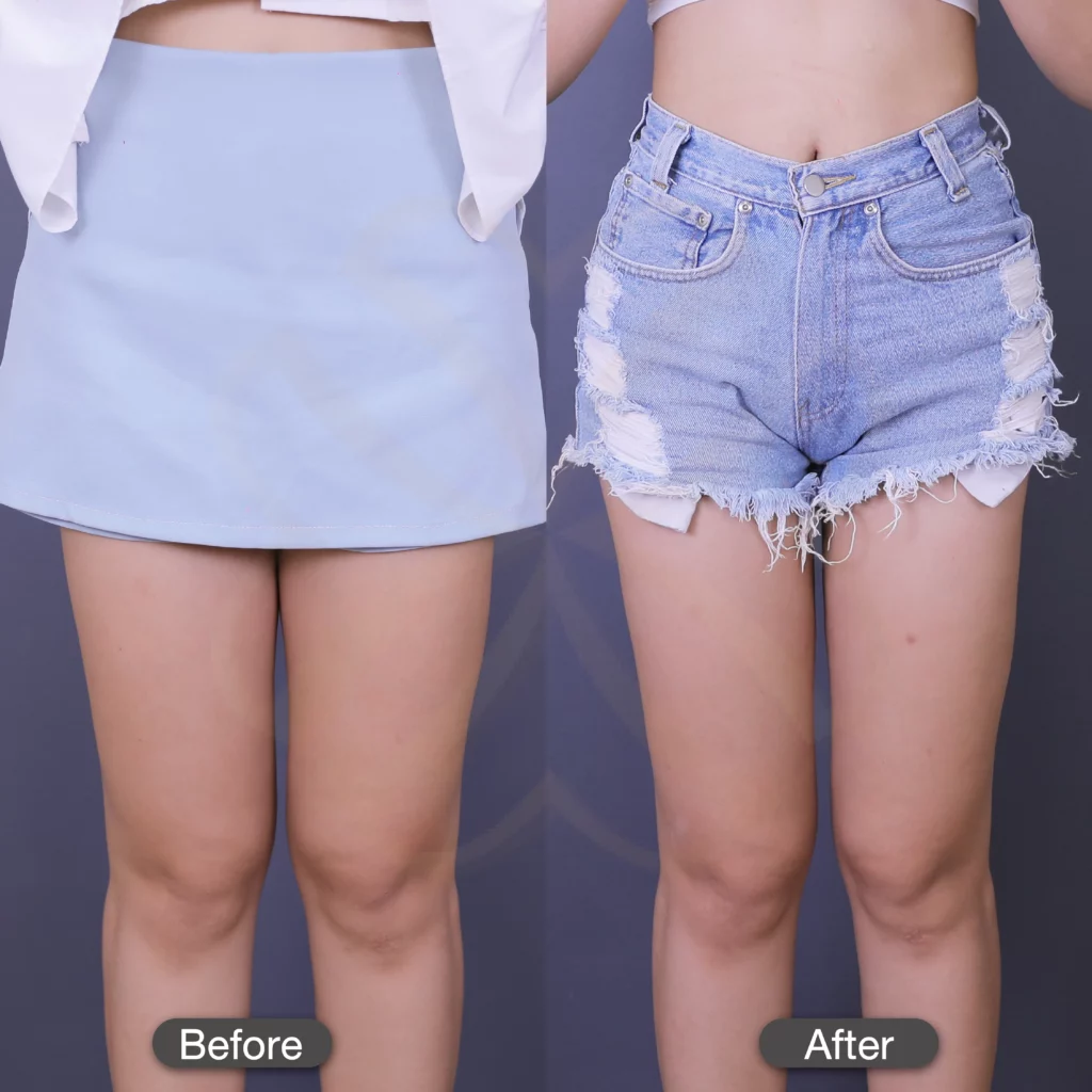 รีวิวดูดไขมันต้นขา ลดไขมันต้นขา