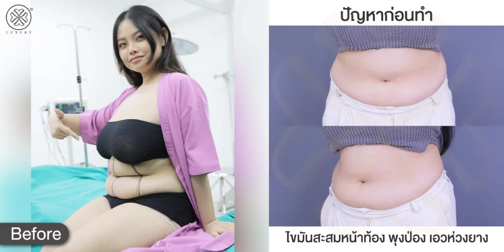 รีวิวดูดไขมัน