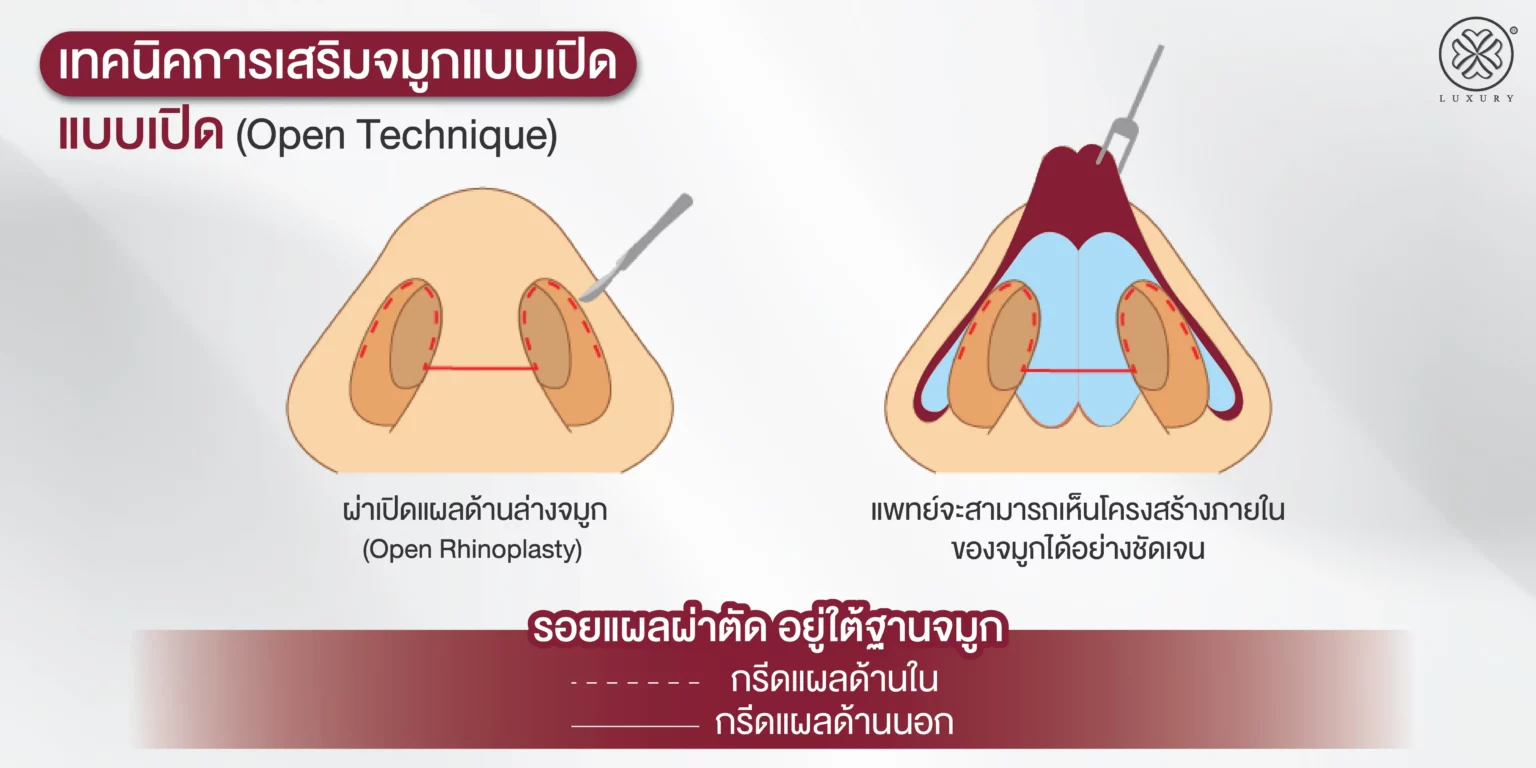 เสริมจมูกโอเพ่นราคาถูก luxury Clinic