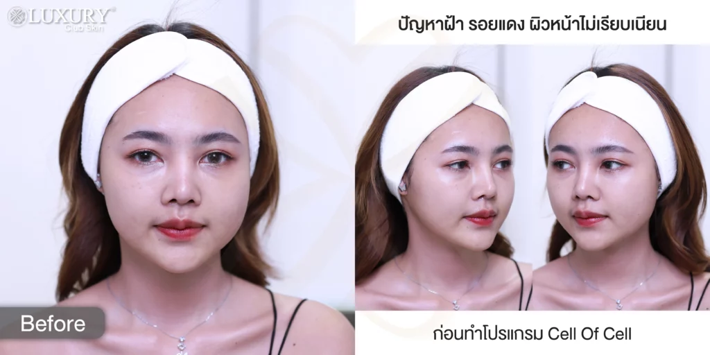 ฝ้า รีวิวรักษาฝ้า