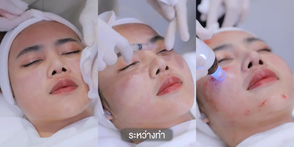 ฝ้า รีวิวรักษาฝ้า