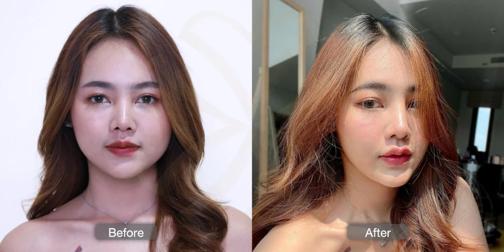 ฝ้า รีวิวรักษาฝ้า