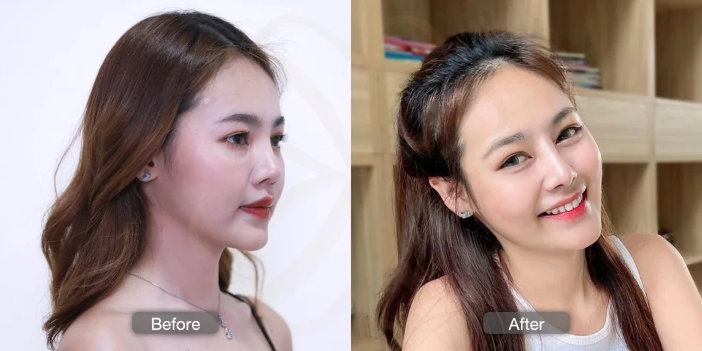 ฝ้า รีวิวรักษาฝ้า