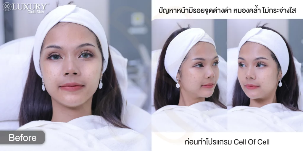 รักษาฝ้า แก้ฝ้า ซ่อมแซมเซลล์