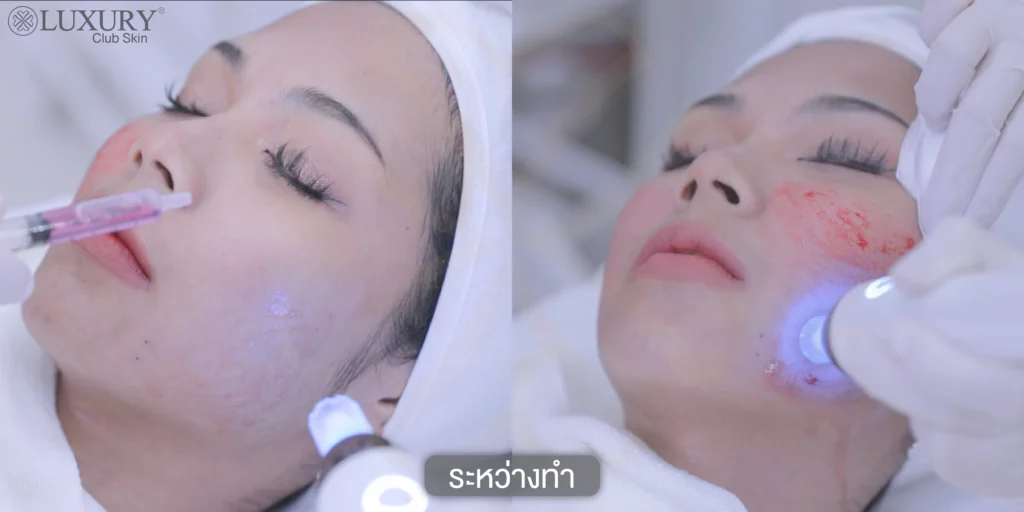 รักษาฝ้า แก้ฝ้า ซ่อมแซมเซลล์
